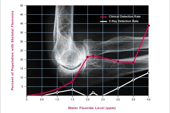 fluoride-skeletal-fluorosis